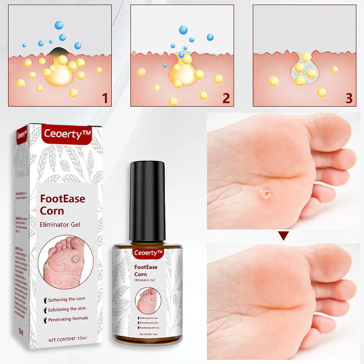Feet Corn Removal Serum ( Pack Of 2 )