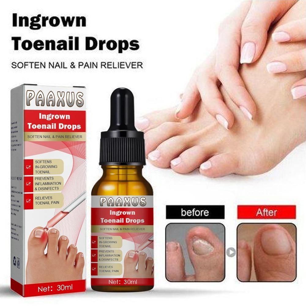 Ingrown Toenail Drops  Pack of 2