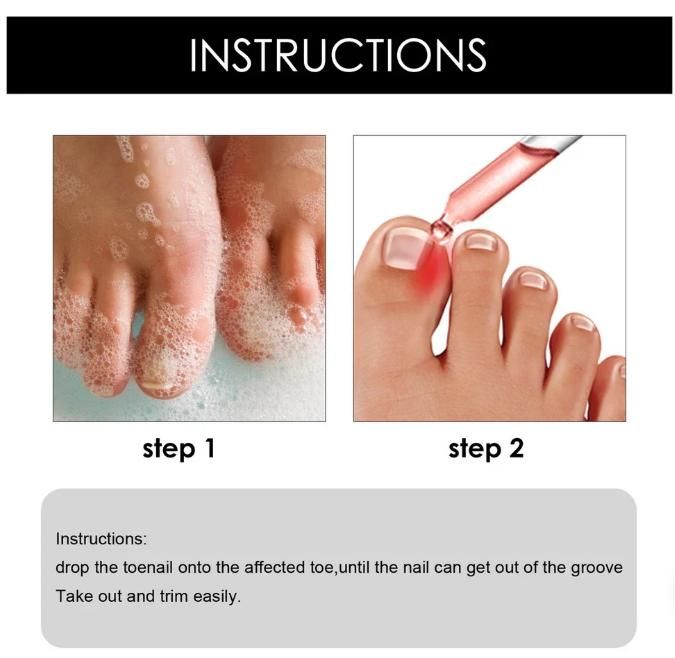 Ingrown Toenail Drops  Pack of 2