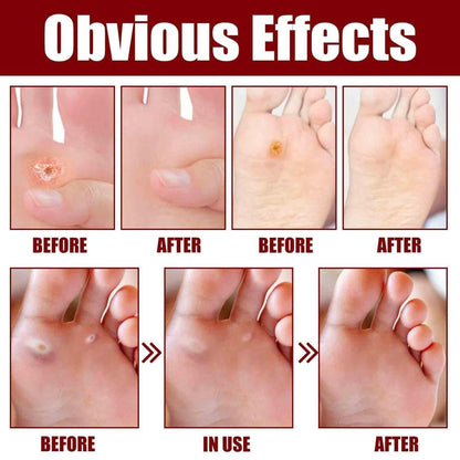 Feet Corn Removal Serum ( Pack Of 2 )